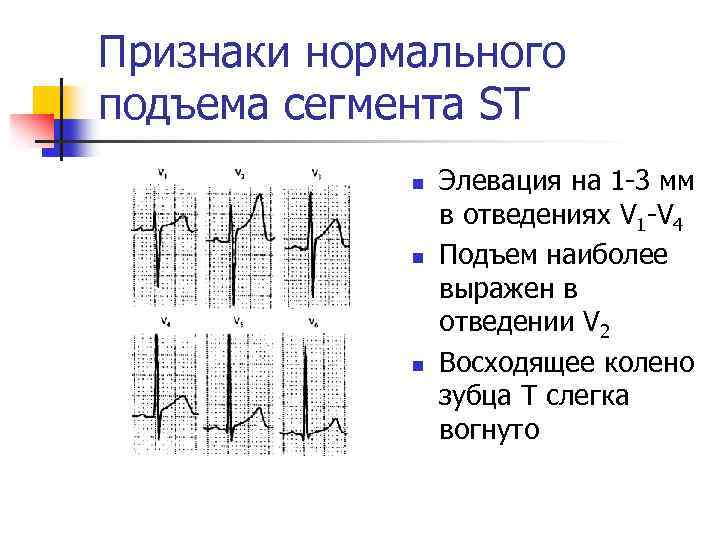 Элевация сегмента st что это