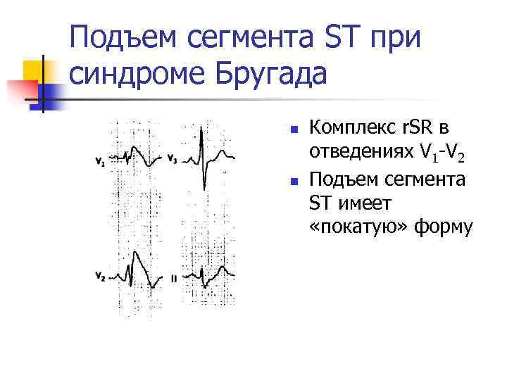 Подъем сегмента. Синдром Бругада в отведении v1 v2. Подъем сегмента St в 1 отведении. Подъем сегмента St в отведениях v2. Форма сегмента St при подъеме.