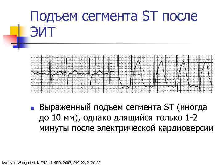 Подъем сегмента ST после ЭИТ n Выраженный подъем сегмента ST (иногда до 10 мм),