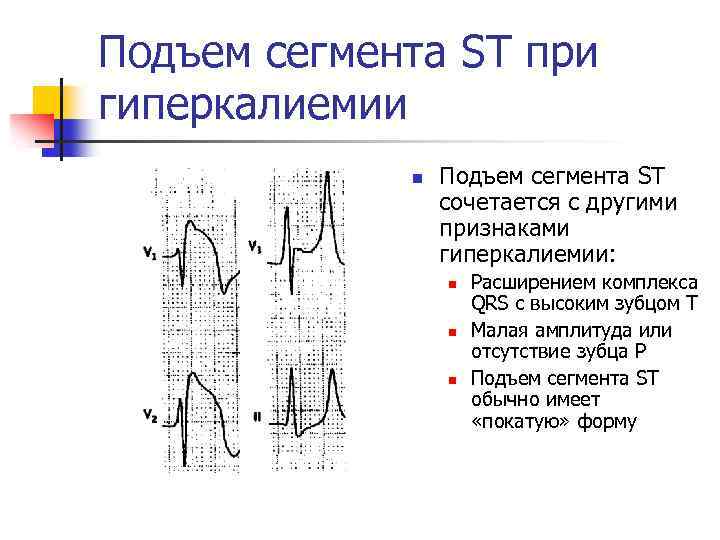Подъем сегмента ST при гиперкалиемии n Подъем сегмента ST сочетается с другими признаками гиперкалиемии: