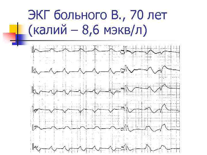 ЭКГ больного В. , 70 лет (калий – 8, 6 мэкв/л) 