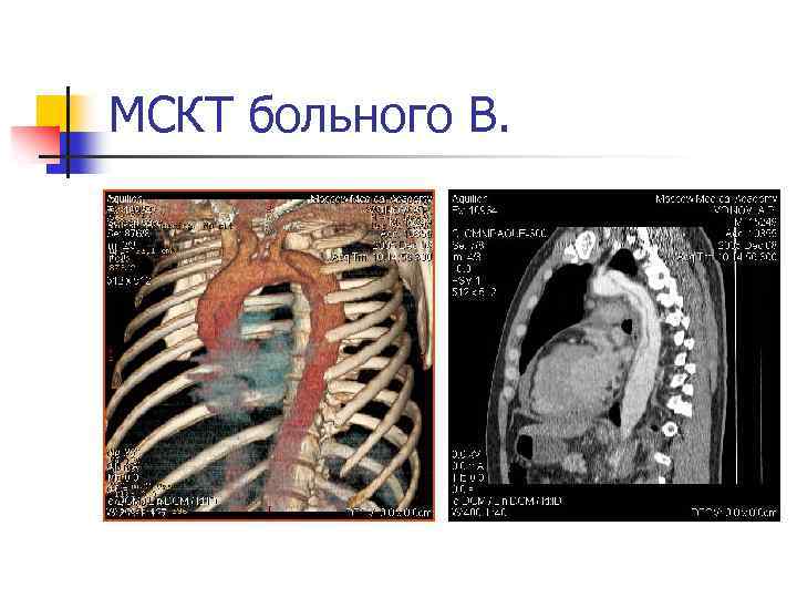МСКТ больного В. 