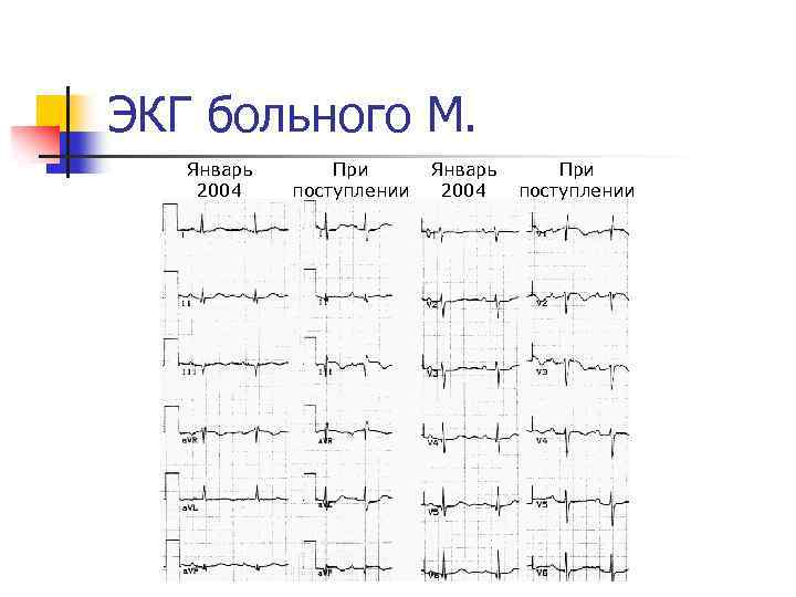 ЭКГ больного М. Январь 2004 При поступлении 