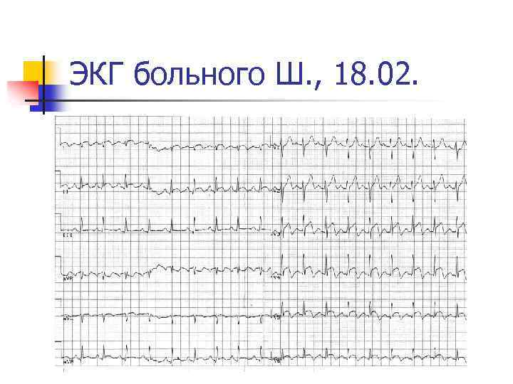 ЭКГ больного Ш. , 18. 02. 