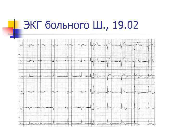 ЭКГ больного Ш. , 19. 02 