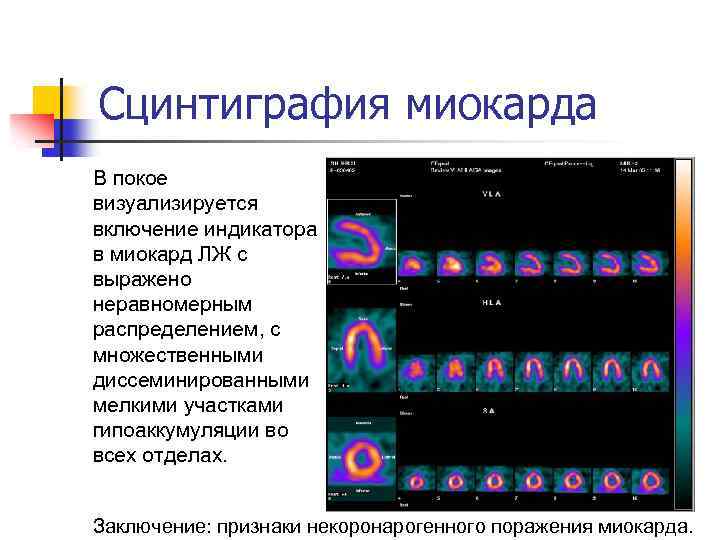 Сцинтиграфия миокарда В покое визуализируется включение индикатора в миокард ЛЖ с выражено неравномерным распределением,