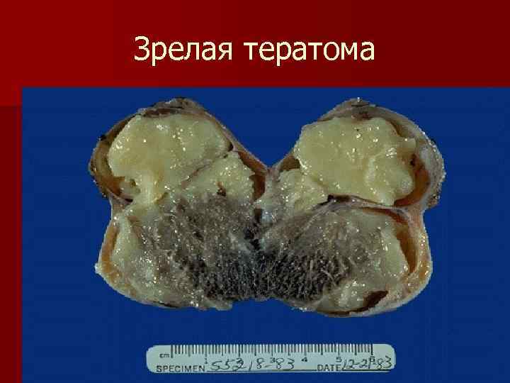 Bilateral Synchronous Mature Ovarian Teratoma And Mucinous Cystadenoma Sule Aa, Ochicha O, Yusuf