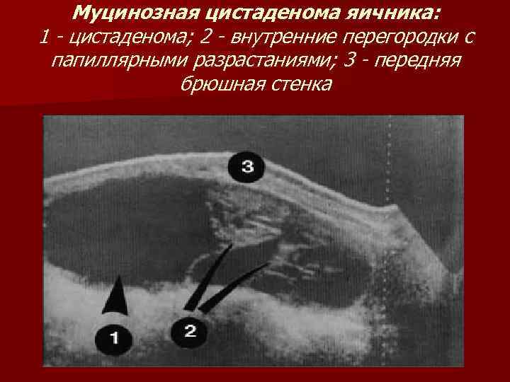 Муцинозная цистаденома яичника: 1 - цистаденома; 2 - внутренние перегородки с папиллярными разрастаниями; 3