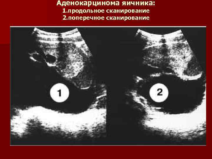 Аденокарцинома яичника: 1. продольное сканирование 2. поперечное сканирование 