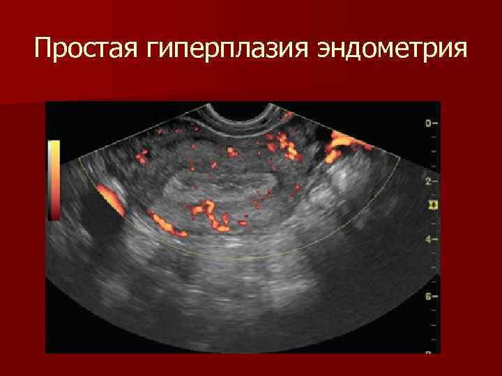 Эндометрия стенок матки. Гиперплазия эндометрия. Эхография гиперплазии эндометрия.