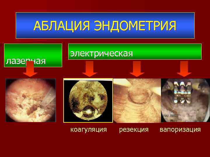 АБЛАЦИЯ ЭНДОМЕТРИЯ лазерная электрическая коагуляция резекция вапоризация 