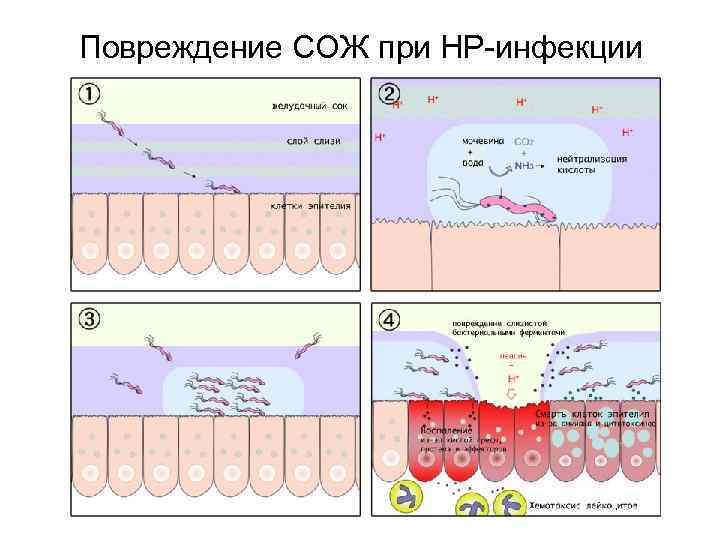 Повреждение СОЖ при НР-инфекции 