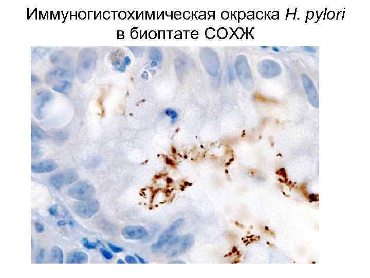 Иммуногистохимическая окраска H. pylori в биоптате СОХЖ 