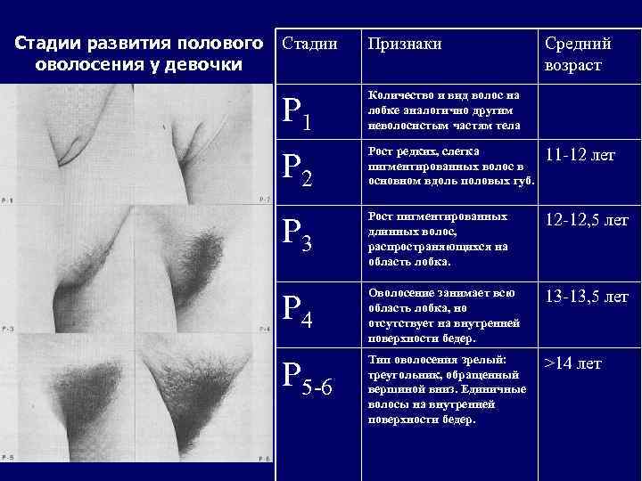 Стадии развития полового Стадии оволосения у девочки Признаки Средний возраст P 1 Количество и
