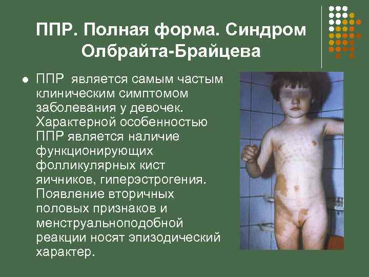 ППР. Полная форма. Синдром Олбрайта-Брайцева l ППР является самым частым клиническим симптомом заболевания у