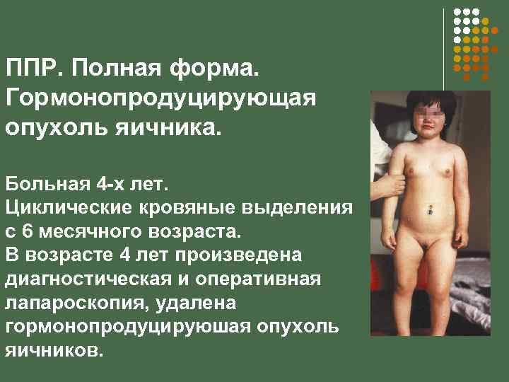 ППР. Полная форма. Гормонопродуцирующая опухоль яичника. Больная 4 -х лет. Циклические кровяные выделения с