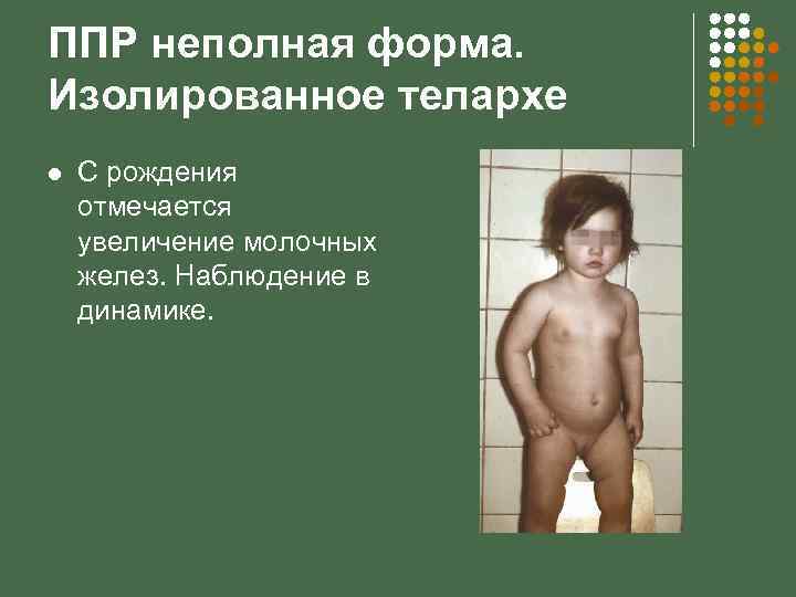 ППР неполная форма. Изолированное телархе l С рождения отмечается увеличение молочных желез. Наблюдение в