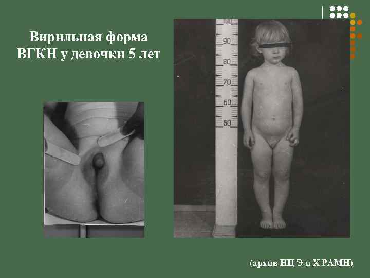 Вирильная форма ВГКН у девочки 5 лет (архив НЦ Э и Х РАМН) 