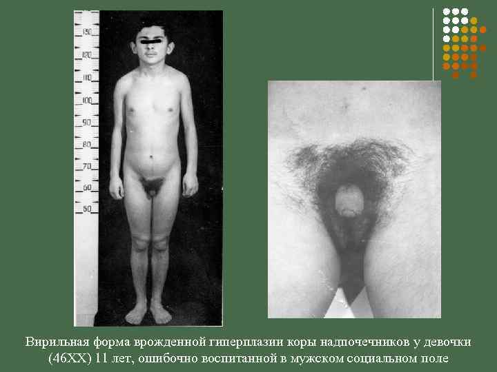 Вирильная форма врожденной гиперплазии коры надпочечников у девочки (46 XX) 11 лет, ошибочно воспитанной