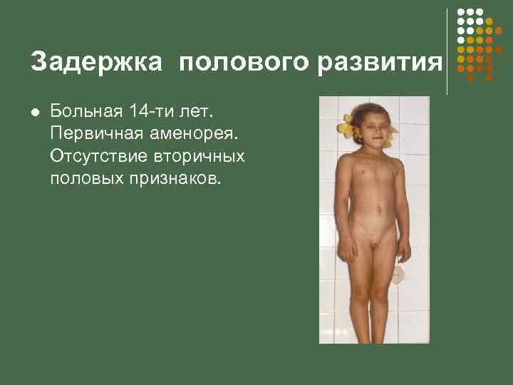 Задержка полового развития l Больная 14 -ти лет. Первичная аменорея. Отсутствие вторичных половых признаков.