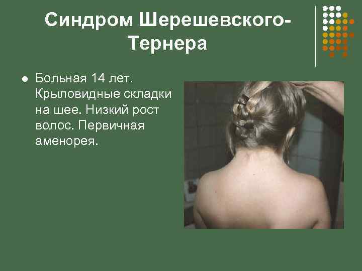 Синдром шерешевского тернера клиническая картина