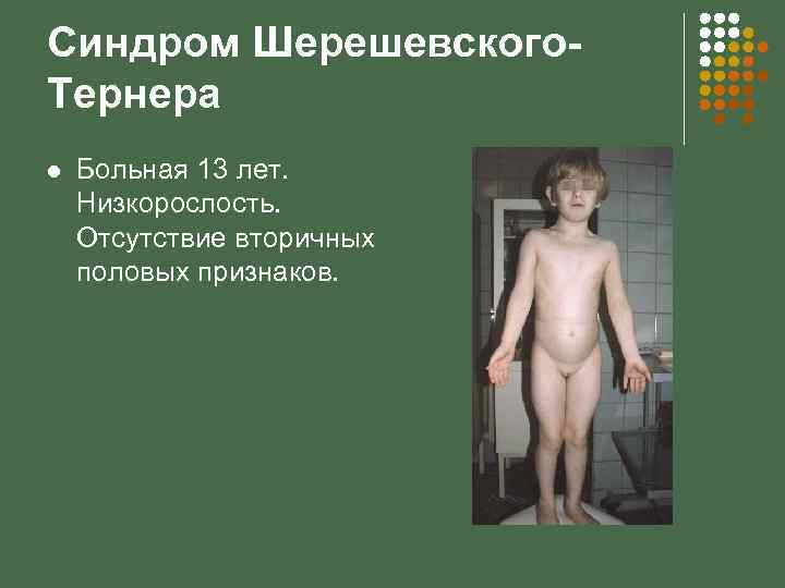 Синдром Шерешевского. Тернера l Больная 13 лет. Низкорослость. Отсутствие вторичных половых признаков. 