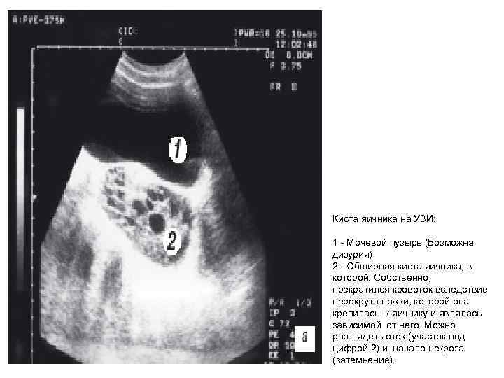 Киста яичника на УЗИ: 1 Мочевой пузырь (Возможна дизурия) 2 Обширная киста яичника, в