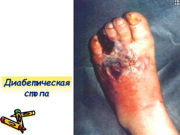 Диабетическая стопа 