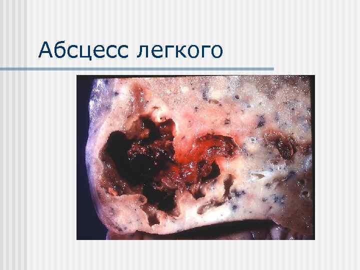 Абсцесс легкого 