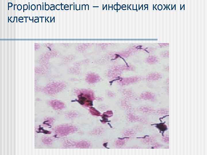 Propionibacterium – инфекция кожи и клетчатки 