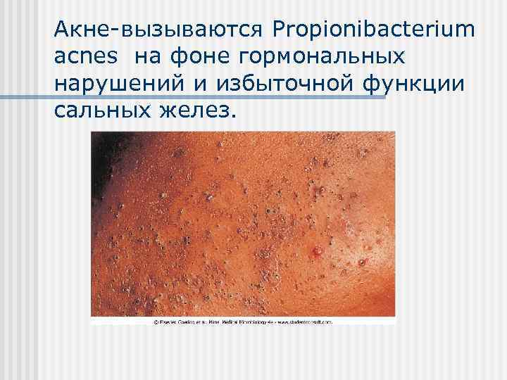 Акне-вызываются Propionibacterium acnes на фоне гормональных нарушений и избыточной функции сальных желез. 