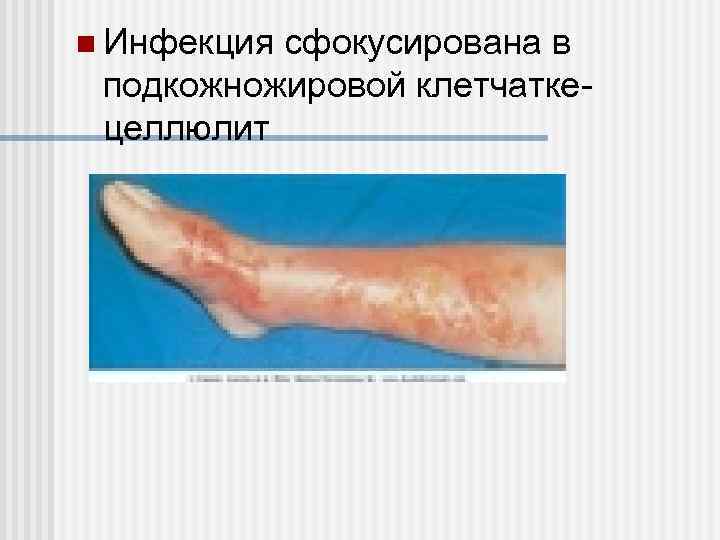 n Инфекция сфокусирована в подкожножировой клетчаткецеллюлит 