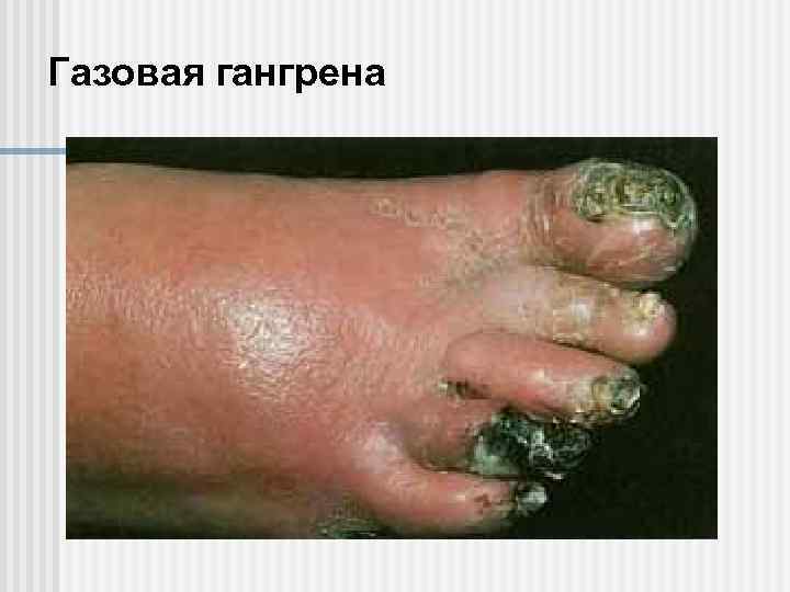 Газовая гангрена 