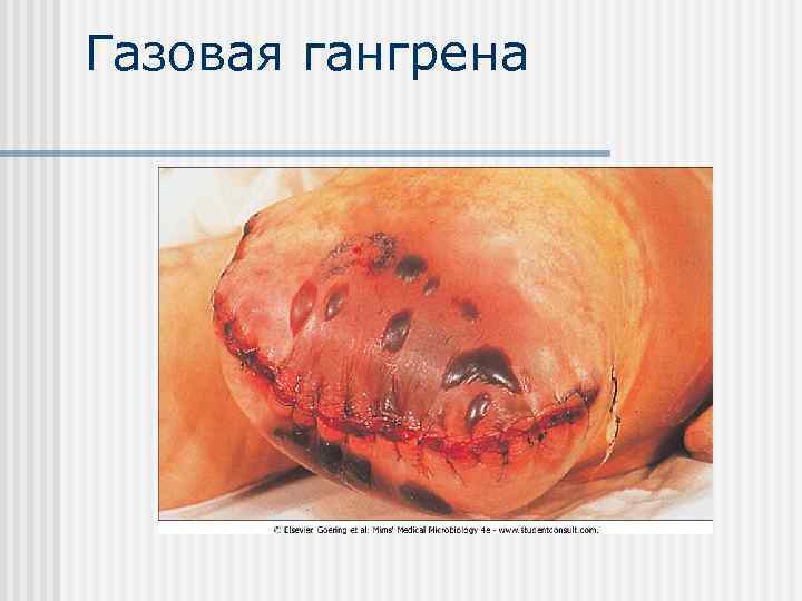 Газовая гангрена 