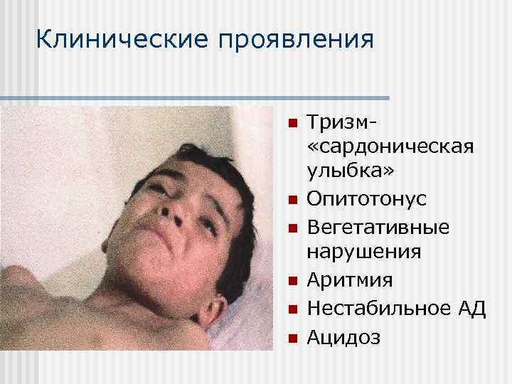 Клинические проявления n n n Тризм «сардоническая улыбка» Опитотонус Вегетативные нарушения Аритмия Нестабильное АД