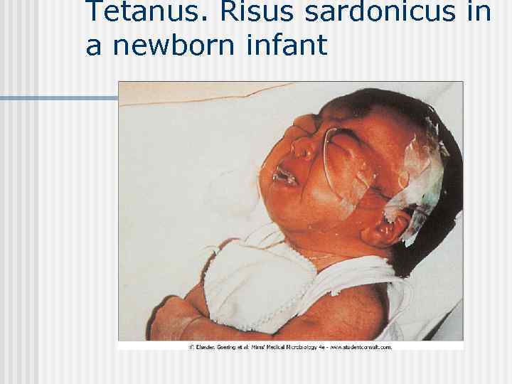 Tetanus. Risus sardonicus in a newborn infant 