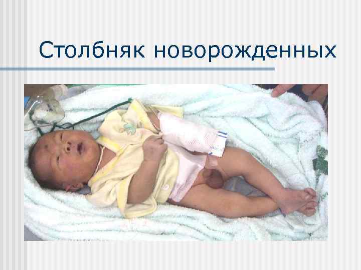 Столбняк новорожденных 