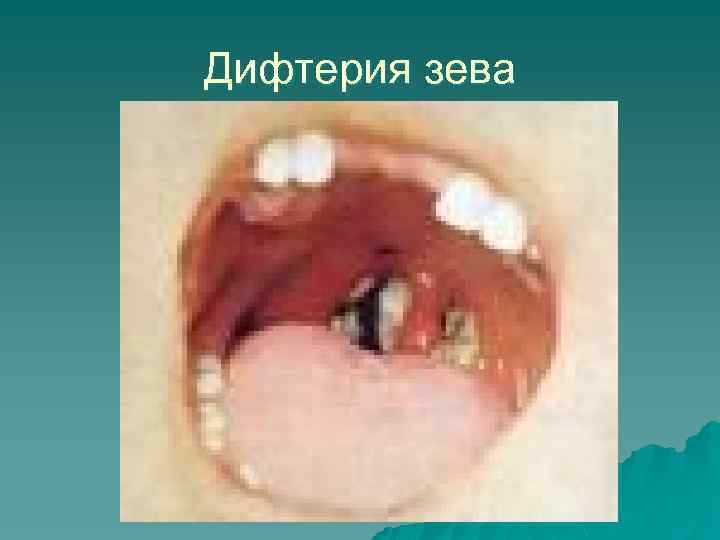 Дифтерия зева 
