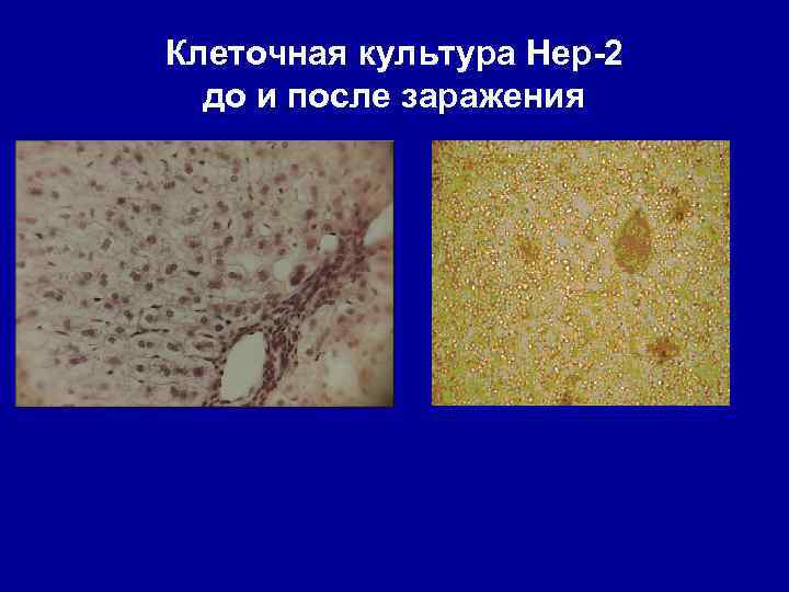 Клеточная культура Hep-2 до и после заражения 