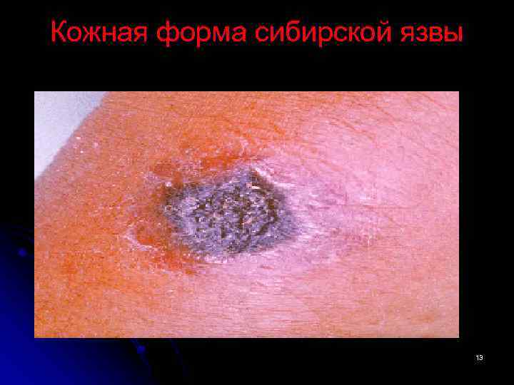 Кожная форма сибирской язвы 13 