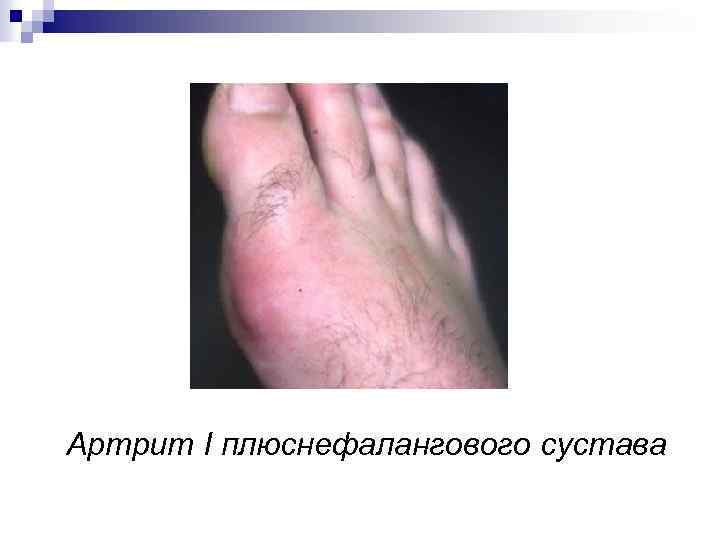 Артрит I плюснефалангового сустава 