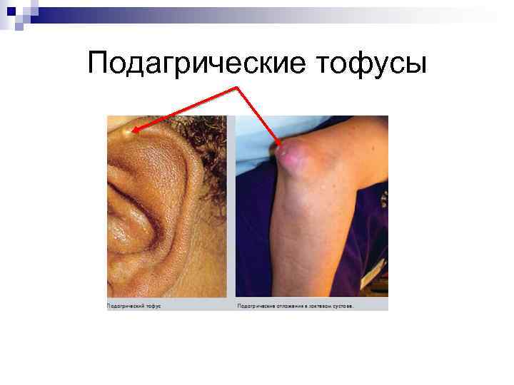 Подагрические тофусы 