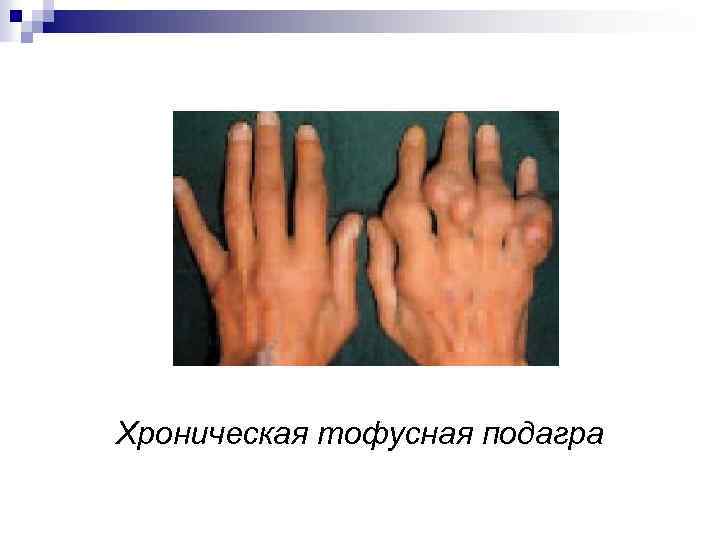 Хроническая тофусная подагра 
