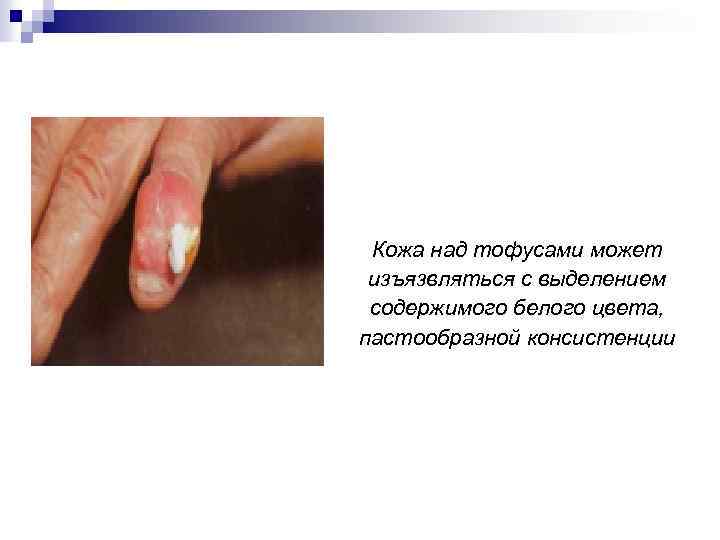 Кожа над тофусами может изъязвляться с выделением содержимого белого цвета, пастообразной консистенции 