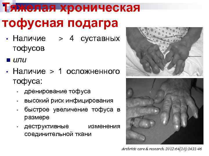 Тяжелая хроническая тофусная подагра Наличие > 4 суставных тофусов n или • Наличие >