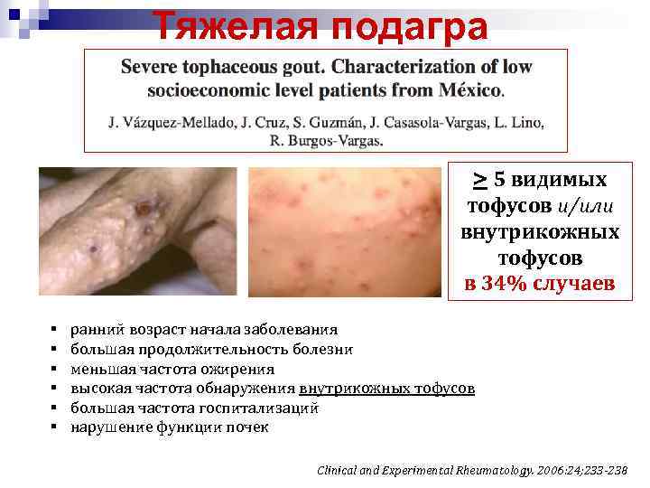Тяжелая подагра > 5 видимых тофусов и/или внутрикожных тофусов в 34% случаев § §