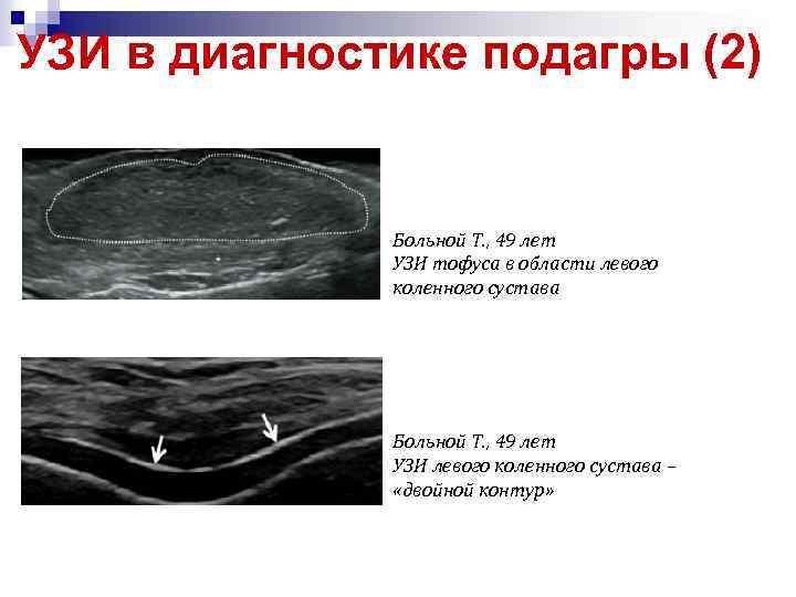 УЗИ в диагностике подагры (2) Больной Т. , 49 лет УЗИ тофуса в области
