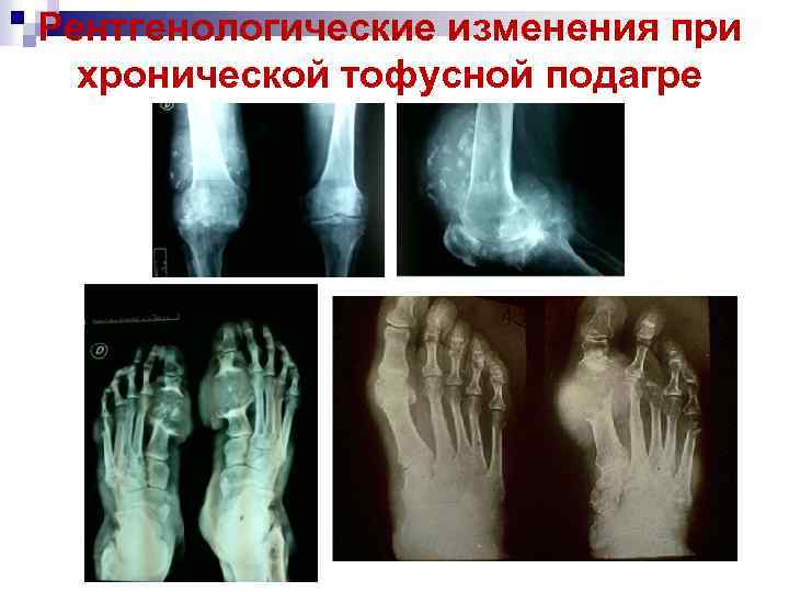 Рентгенологические изменения при хронической тофусной подагре 