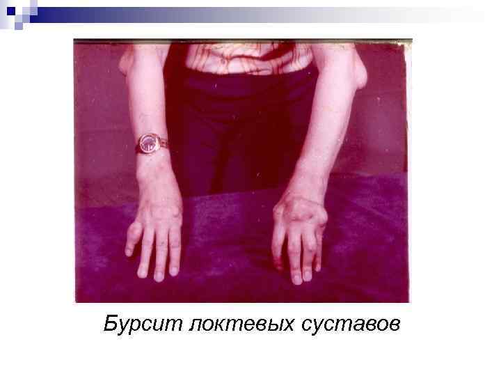 Бурсит локтевых суставов 