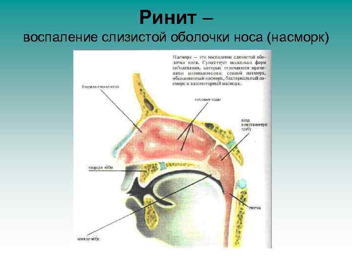 Ринит – воспаление слизистой оболочки носа (насморк) 